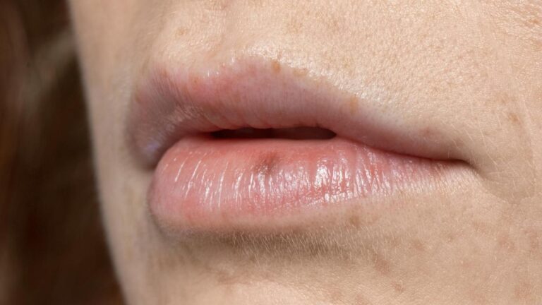 Cáncer labial: Cómo prevenirlo, señales de alerta y lo que no se debería pasar por alto