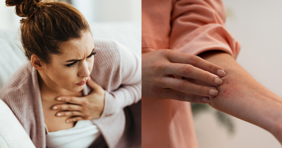 Reacción alérgica severa: cómo identificar sus síntomas a tiempo y qué hacer en una emergencia