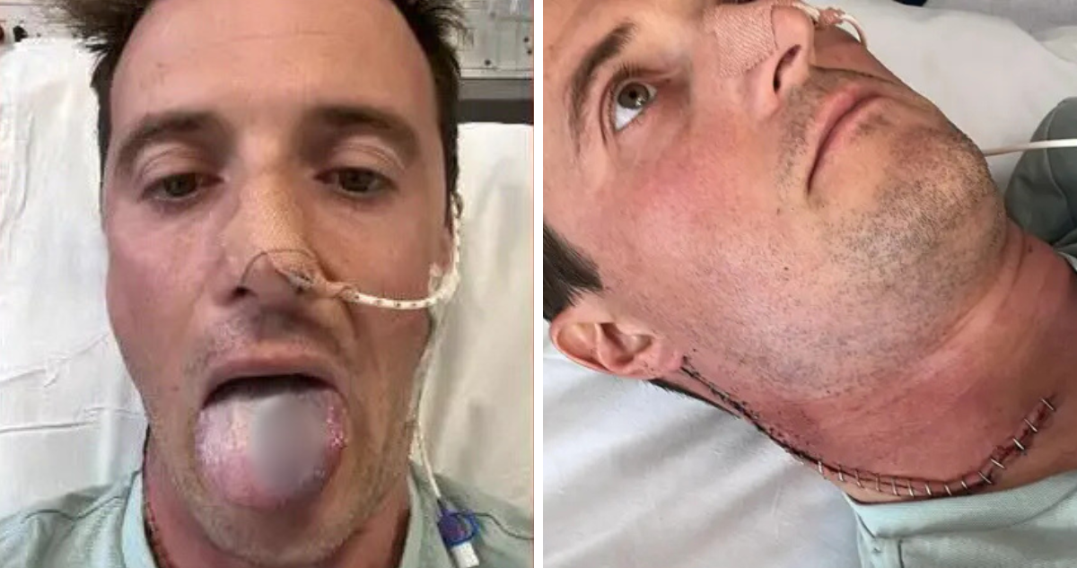 Hombre advierte sobre el Virus del Papiloma Humano: casi perdió su lengua tras desarrollar cáncer