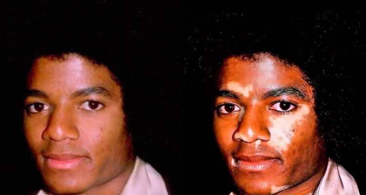 Todo lo que se sabe del vitiligo: el caso de Michael Jackson y el tratamiento que usó para ocultarlo