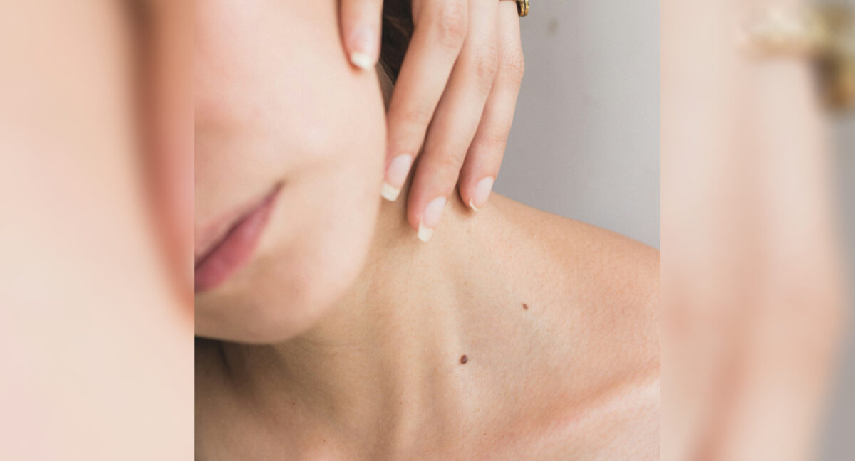 El protector solar no es suficiente: Dermatóloga explicó cómo reconocer el melanoma y los cuidados que se deben tener con los lunares