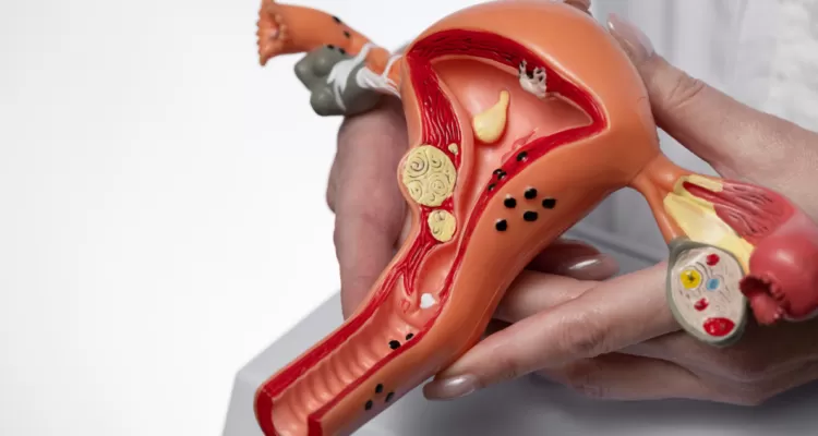 Torsión de ovarios: la emergencia ginecológica que suele confundirse con un simple dolor abdominal